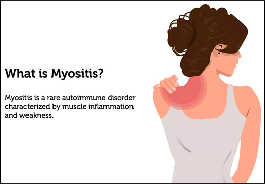 What Is Myositis & Its Treatment In Ayurveda With Herbal Medications - Dr. Vikram's Blog