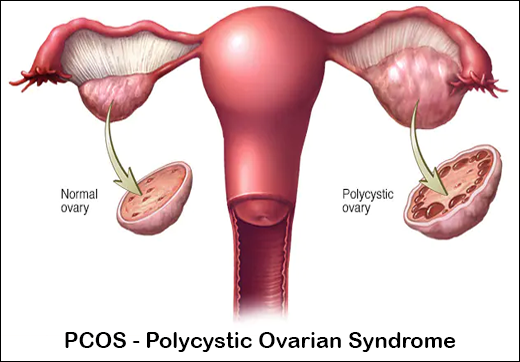 Ayurvedic Treatment For Managing C-Reactive Protein In PCOS With Herbal Remedies - Dr. Vikram's Blog