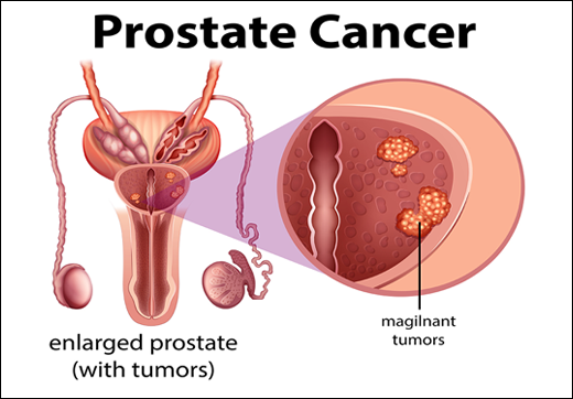 Herbal Remedies for Prostate Cancer - Dr. Vikram's Blog