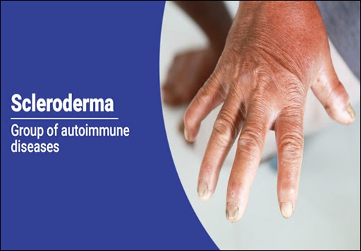 How To Treat Scleroderma With Ayurveda? - Dr. Vikram's Blog